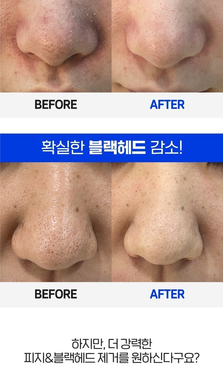 국산 아쿠아필링기 얼굴 코 피지 제거 워터필링 초음파 각질제거기 라벨르L8